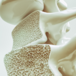 OSTEOPOROSE: CAUSAS, SINTOMAS E PREVENÇÃO