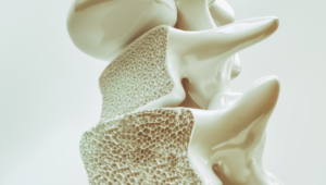 OSTEOPOROSE: CAUSAS, SINTOMAS E PREVENÇÃO