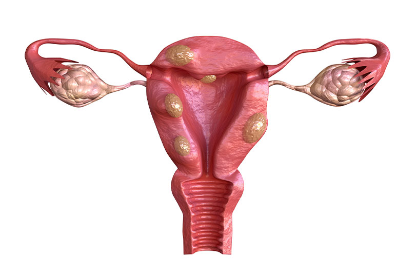 Sangramento em excesso na menstruação pode ser mioma; entenda